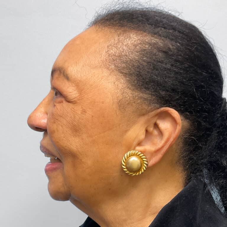 After Image: Upper Blepharoplasty – Dr. Tucker - left-side