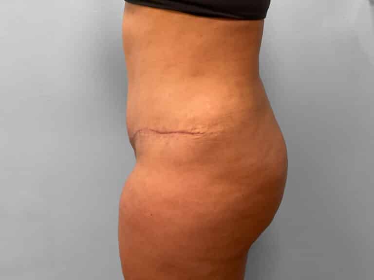 After Image: Abdominoplasty & Lipo – Dr. Tucker - left-side