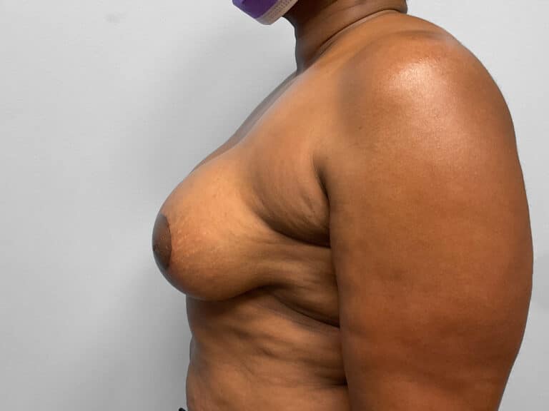 After Image: Breast Augmentation & Lift – Dr. Tucker - left-side