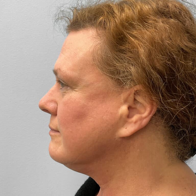After Image: Upper Blepharoplasty – Dr. Tucker - left-side