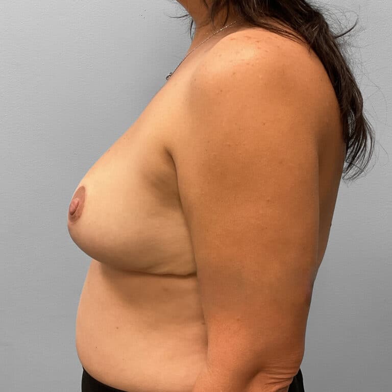 After Image: Breast Reduction – Dr. Tucker - left-side