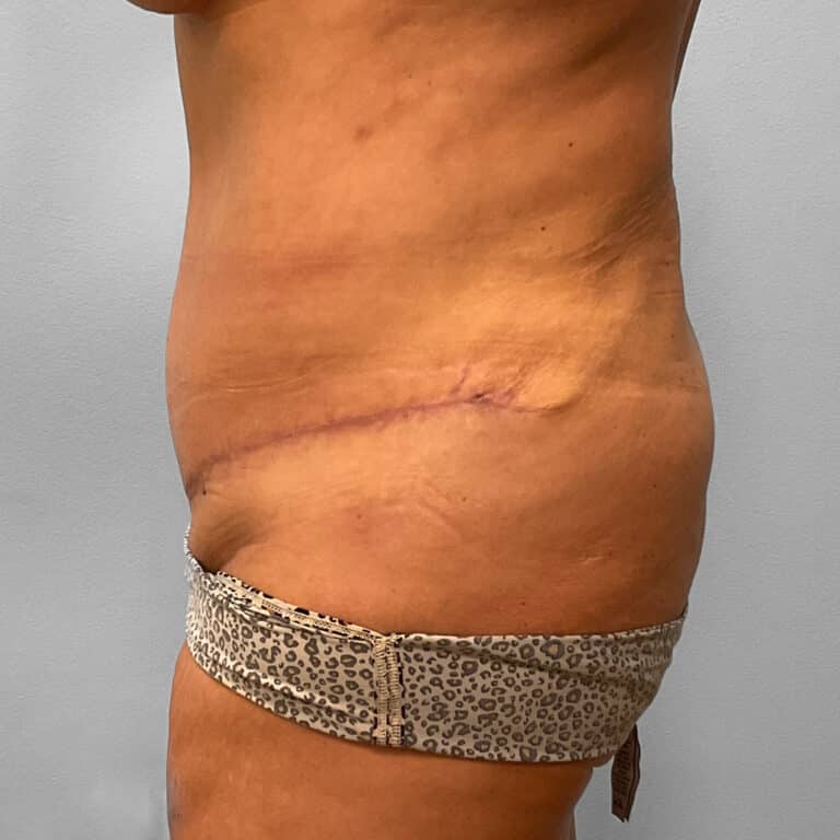 After Image: Tummy Tuck & Lipo – Dr. Tucker - left-side