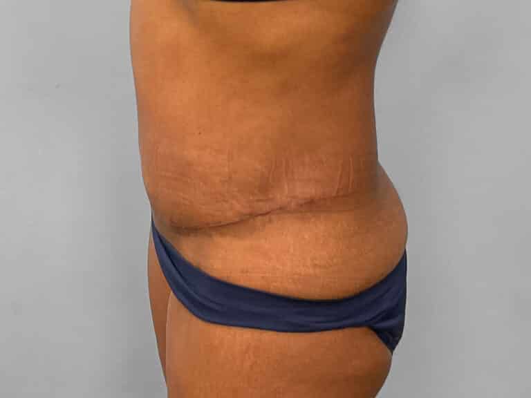 After Image: Tummy Tuck & Lipo – Dr. Tucker - left-side