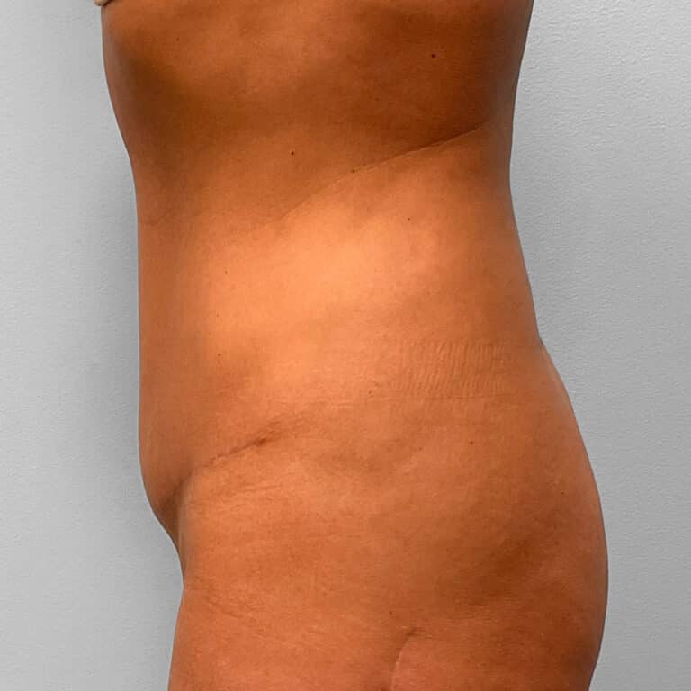 After Image: Mini Tummy Tuck & Lipo – Dr. Tucker - left-side