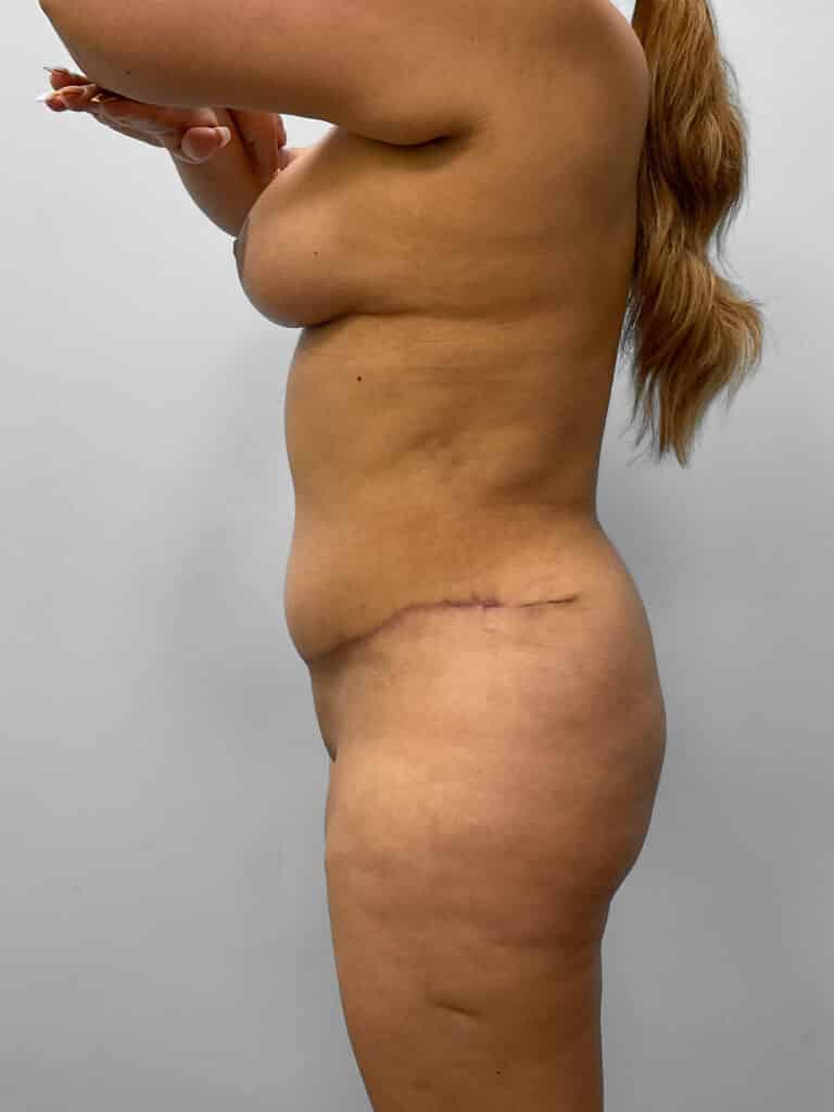 After Image: Mommy Makeover – Dr. Tucker - left-side