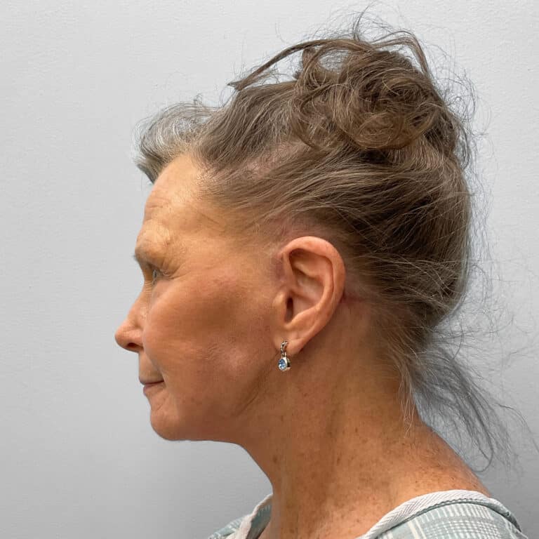 After Image: Facelift – Dr. Tucker - left-side