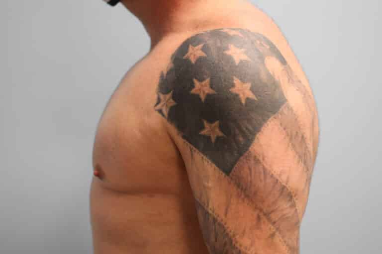 After Image: Gynecomastia Surgery – Dr. Tucker - left-side