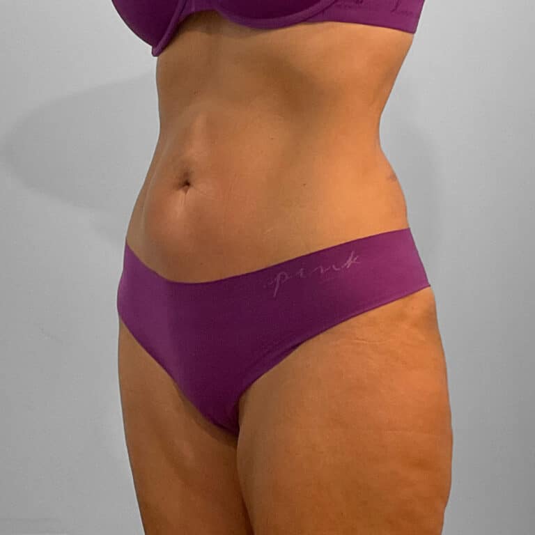 After Image: Emsculpt Neo – Jessica - left-front-oblique