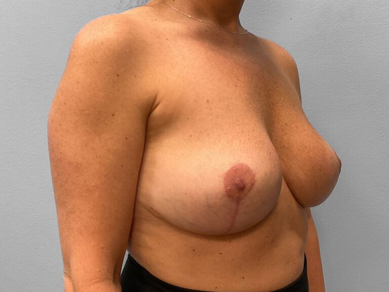 After Image: Breast Lift & Implant Removal – Dr. Tucker - right-front-oblique