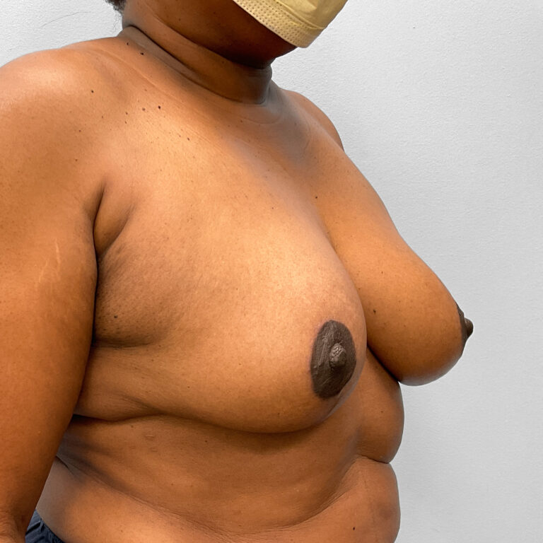 After Image: Breast Augmentation – Dr. Tucker - right-front-oblique
