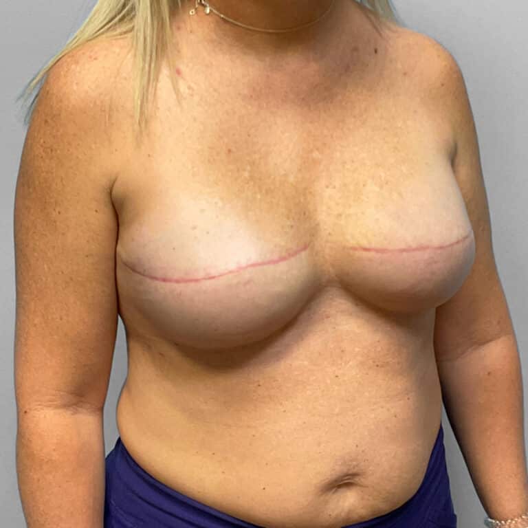 After Image: Breast Reconstruction – Dr. Tucker - right-front-oblique