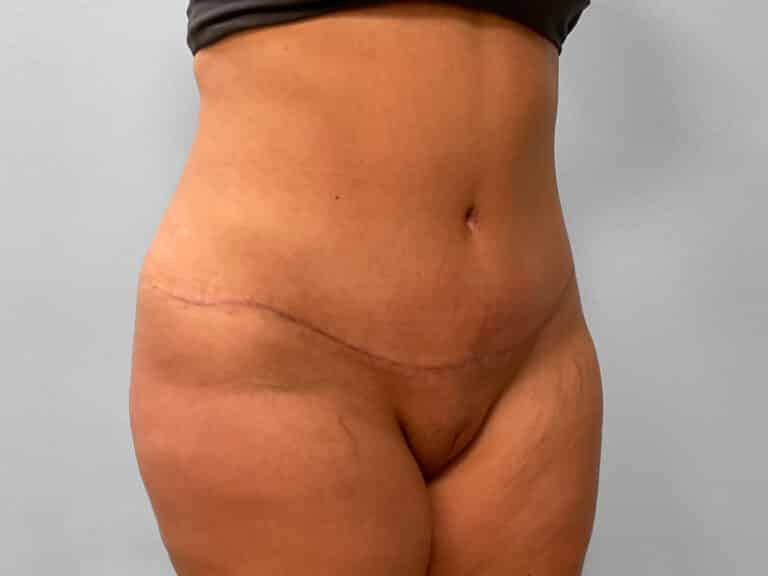 After Image: Abdominoplasty & Lipo – Dr. Tucker - right-front-oblique
