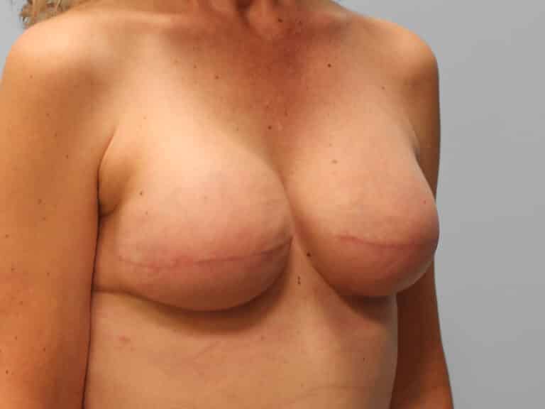 After Image: Breast Reconstruction – Dr. Tucker - right-front-oblique