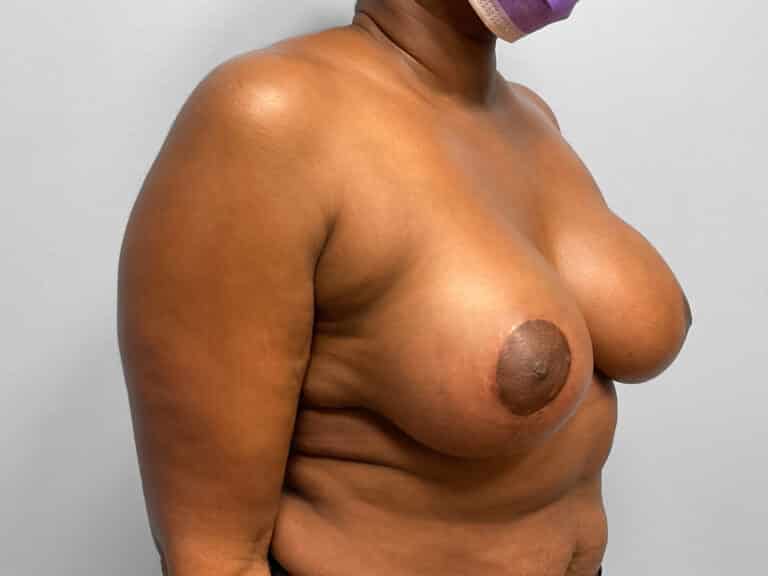 After Image: Breast Augmentation & Lift – Dr. Tucker - right-front-oblique