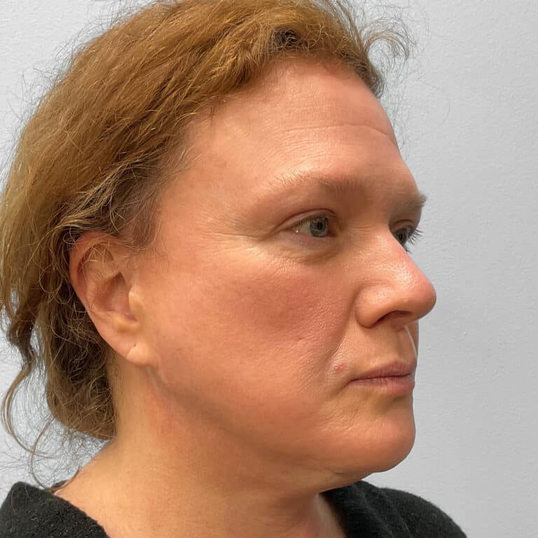 After Image: Upper Blepharoplasty – Dr. Tucker - right-front-oblique