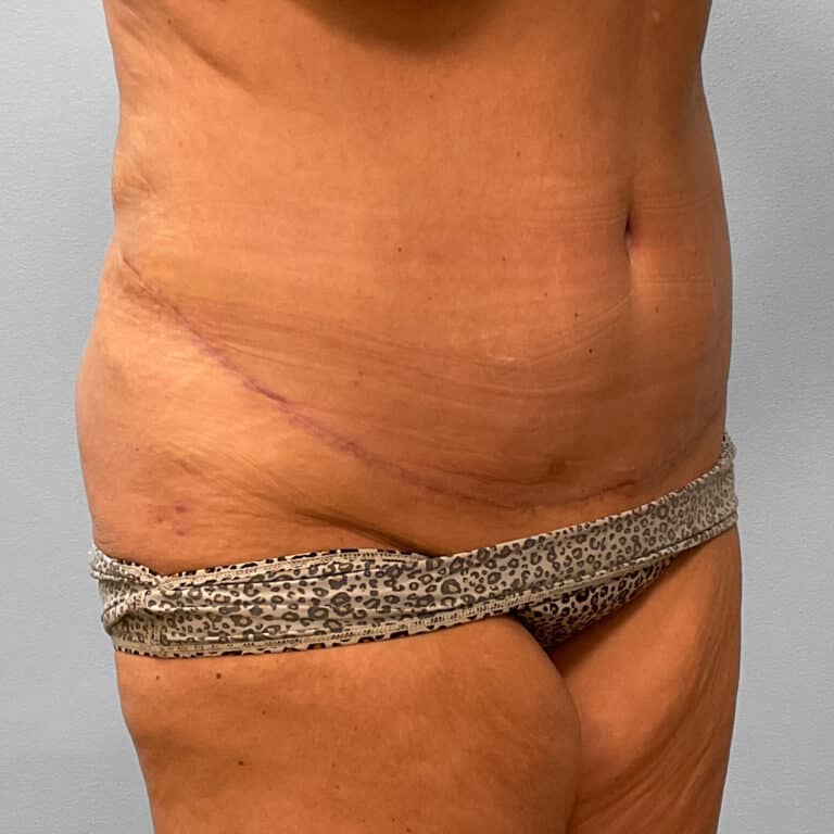 After Image: Tummy Tuck & Lipo – Dr. Tucker - right-front-oblique