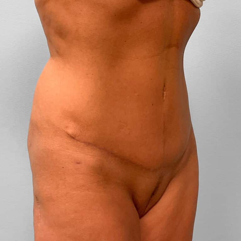 After Image: Mini Tummy Tuck & Lipo – Dr. Tucker - right-front-oblique