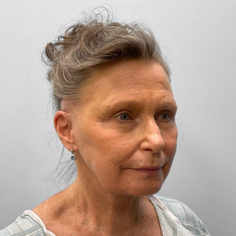 After Image: Facelift – Dr. Tucker - right-front-oblique