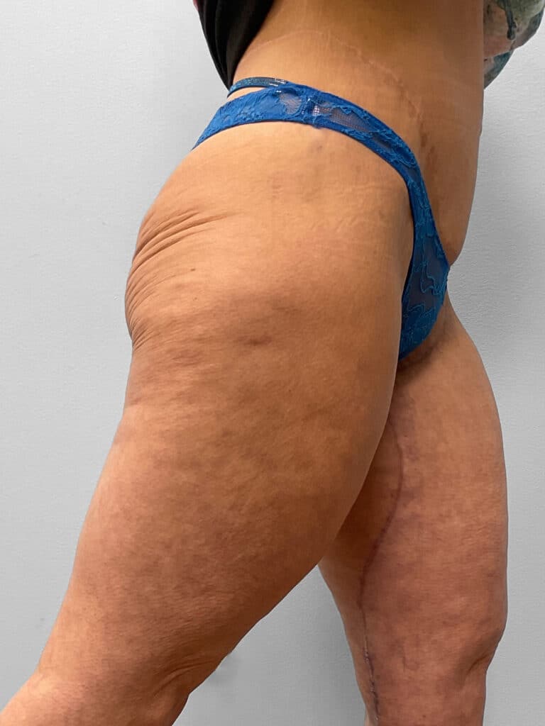 After Image: Medial Thigh Lift – Dr. Tucker - right-front-oblique