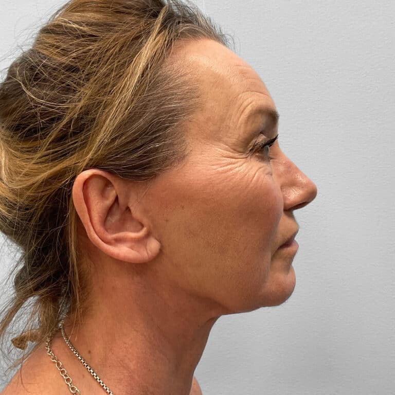 After Image: Facelift & TFX – Dr. Tucker - right-side