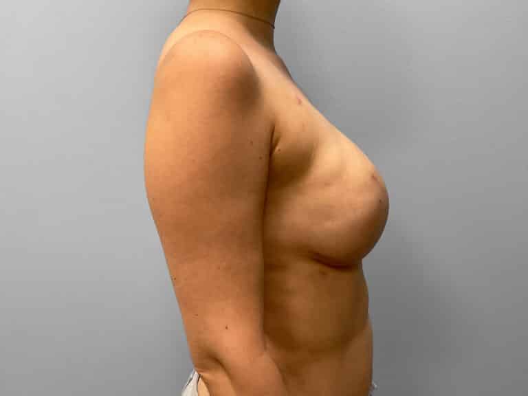 After Image: Breast Reconstruction – Dr. Tucker - right-side