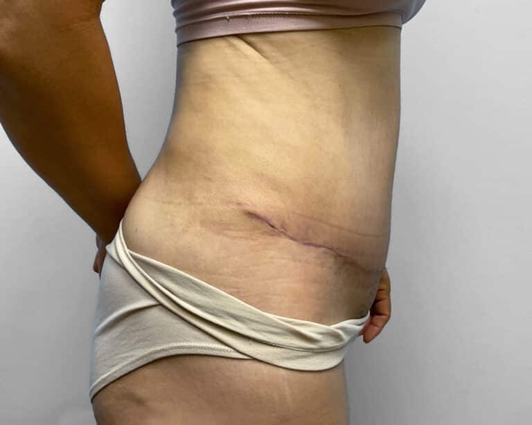 After Image: Tummy Tuck, BBL, & Lipo – Dr. Tucker - right-side