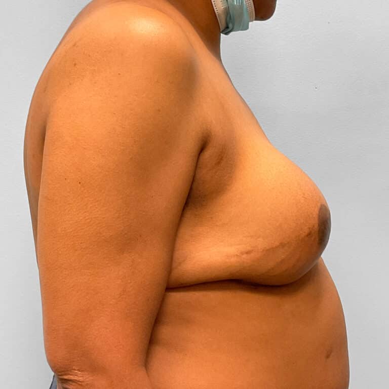 After Image: Breast Reconstruction – Dr. Tucker - right-side