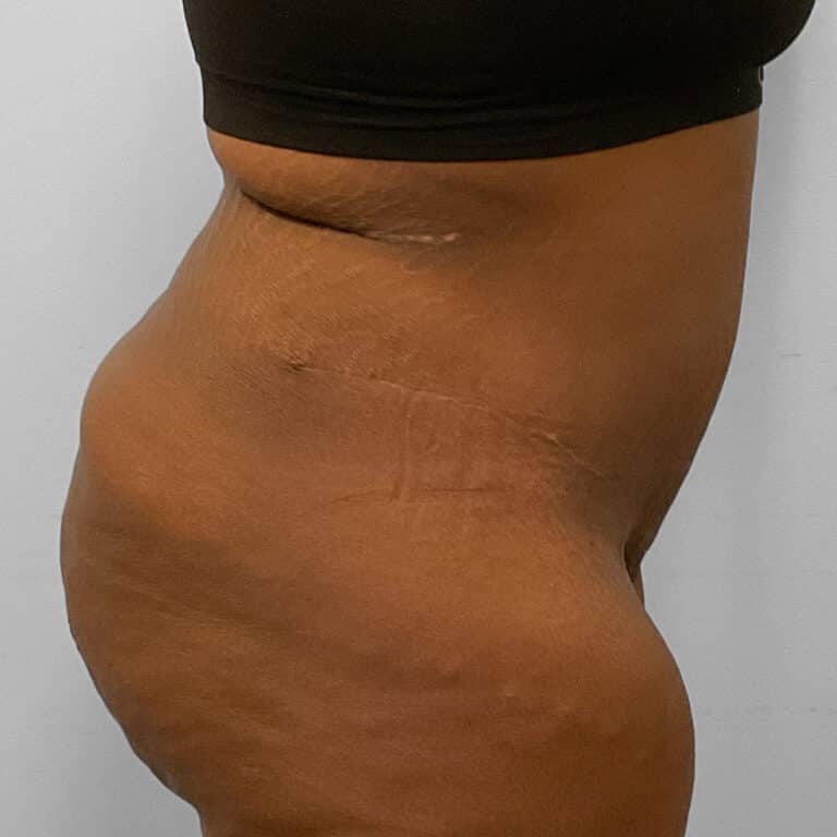 After Image: Abdominoplasty & Lipo – Dr. Tucker - right-side