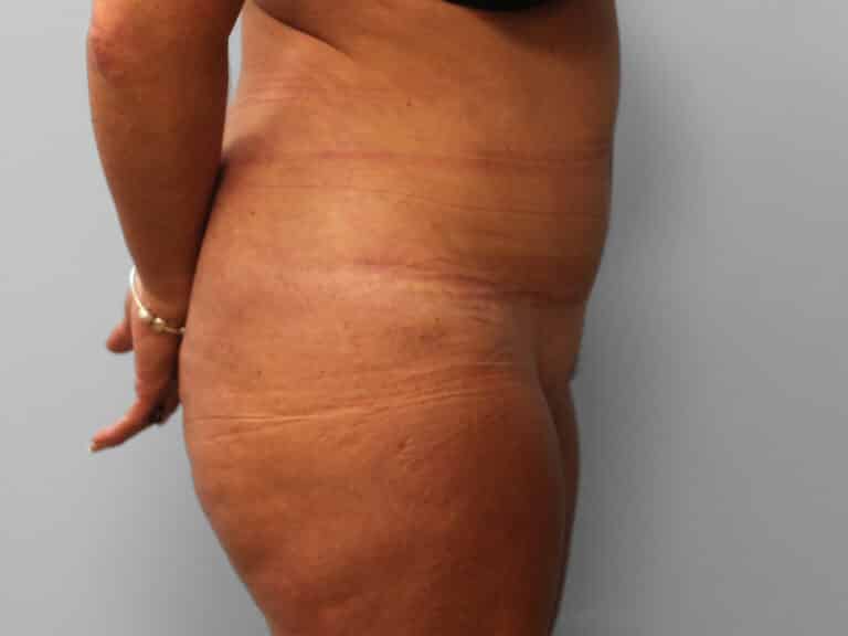 After Image: Abdominoplasty & Lipo – Dr. Tucker - right-side
