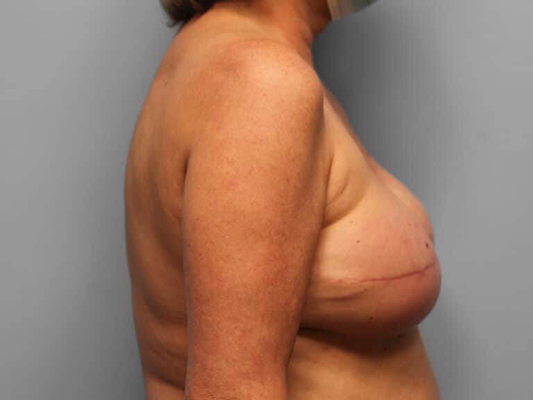 After Image: Breast Reconstruction – Dr. Tucker - right-side