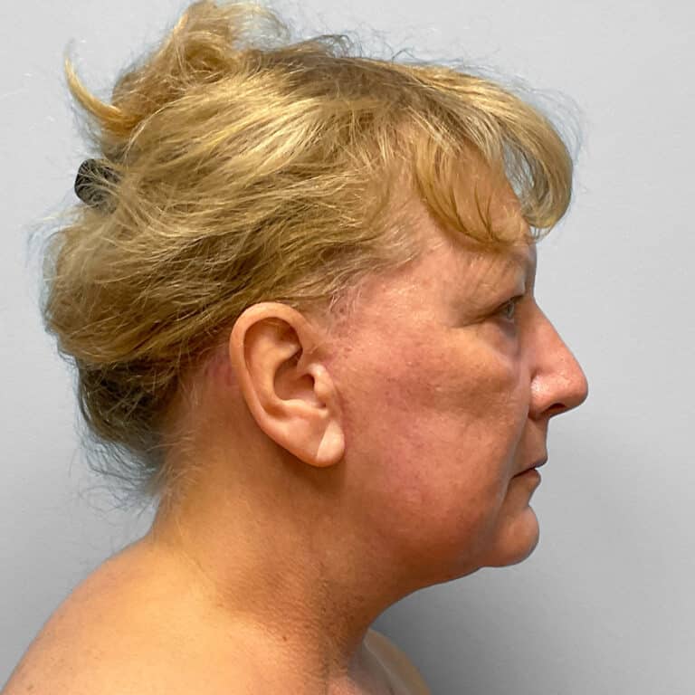 After Image: Facelift & TFX – Dr. Tucker - right-side