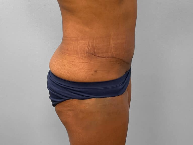 After Image: Tummy Tuck & Lipo – Dr. Tucker - right-side