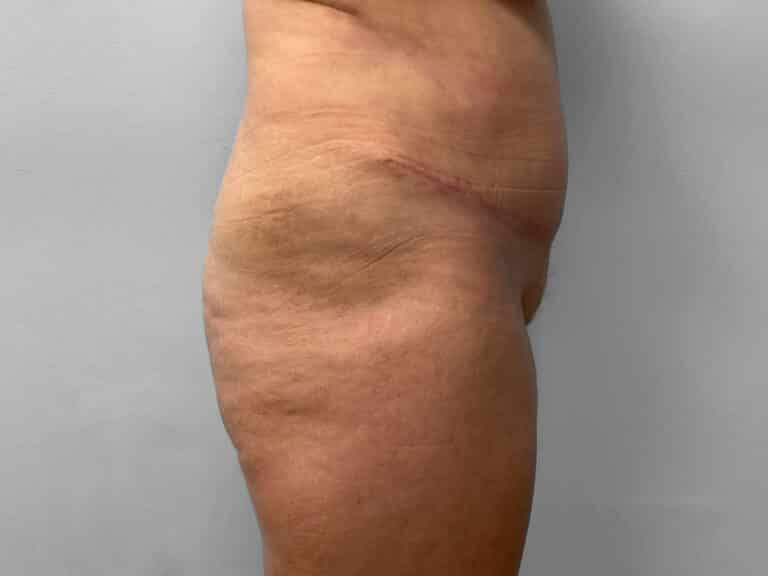 After Image: Tummy Tuck & Lipo – Dr. Tucker - right-side
