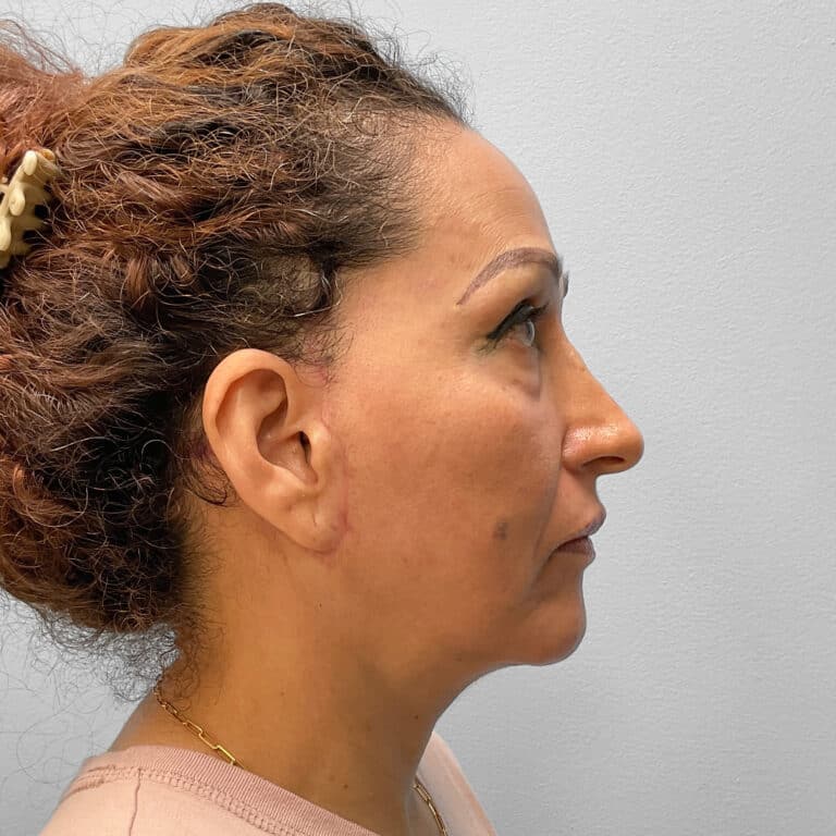 After Image: Facelift & Laser Resurfacing – Dr. Tucker - right-side