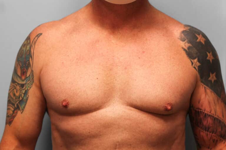 Before Image: Gynecomastia Surgery – Dr. Tucker - front
