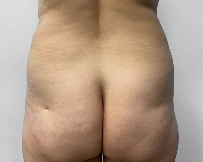 Before Image: Tummy Tuck, BBL, & Lipo – Dr. Tucker - back