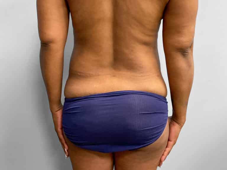 Before Image: Tummy Tuck & Lipo – Dr. Tucker - back