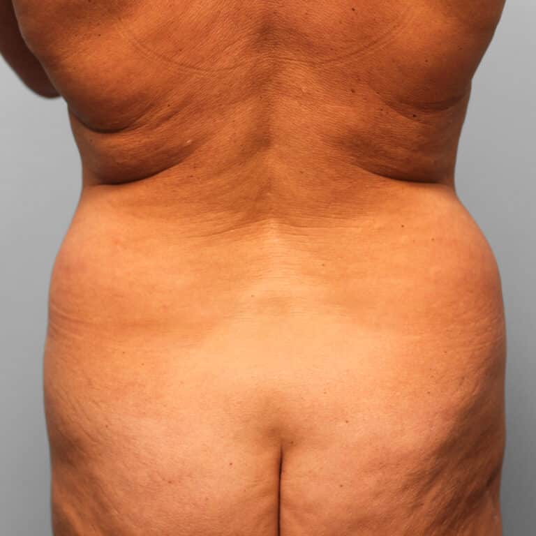 Before Image: Mini Tummy Tuck & Lipo – Dr. Tucker - back