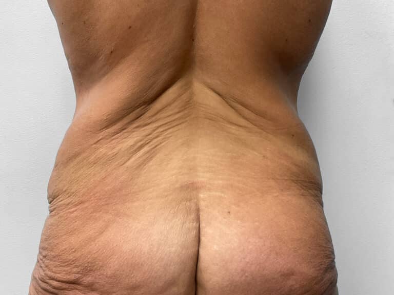 Before Image: Body Lift – Dr. Tucker - back