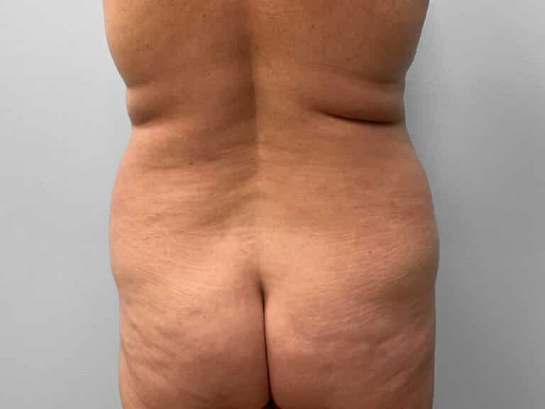 Before Image: Tummy Tuck & Lipo – Dr. Tucker - back