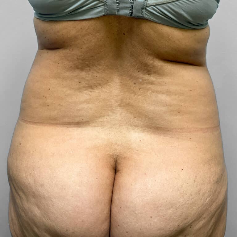 Before Image: Tummy Tuck & Lipo – Dr. Tucker - back