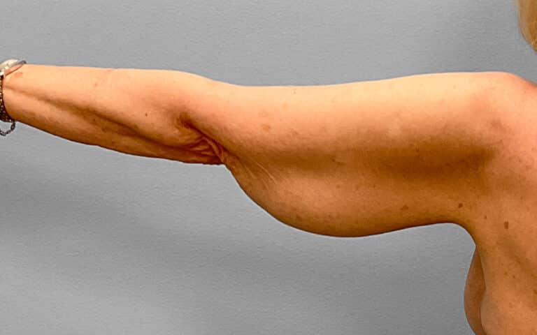 Before Image: Arm Lift – Dr. Tucker - back