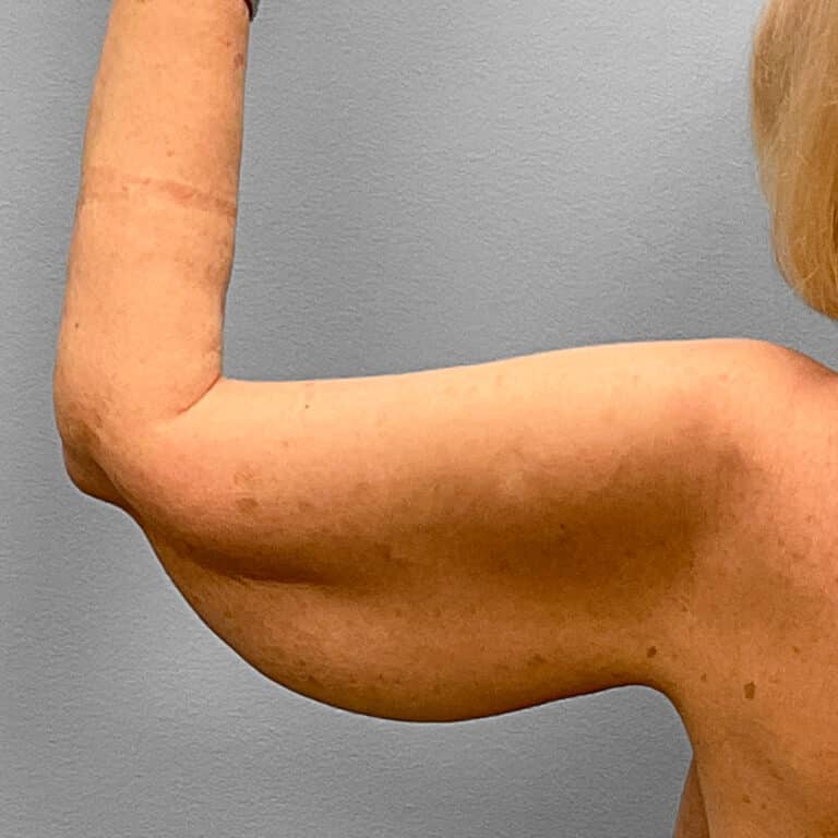 Before Image: Arm Lift – Dr. Tucker - back