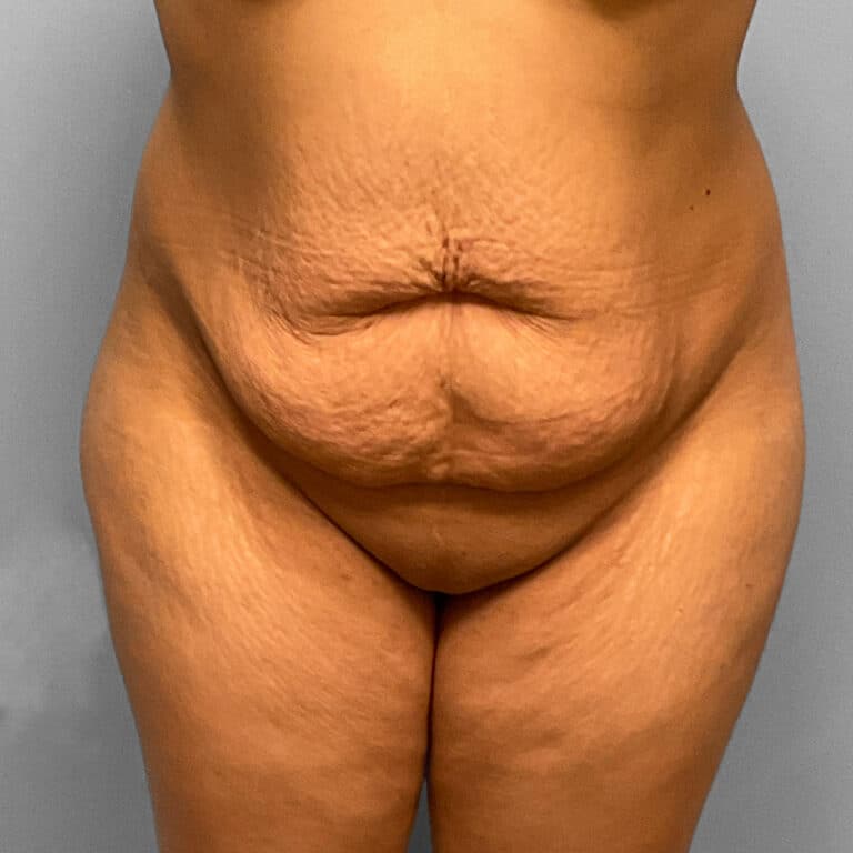 Before Image: Abdominoplasty & Lipo Dr. Tucker - front