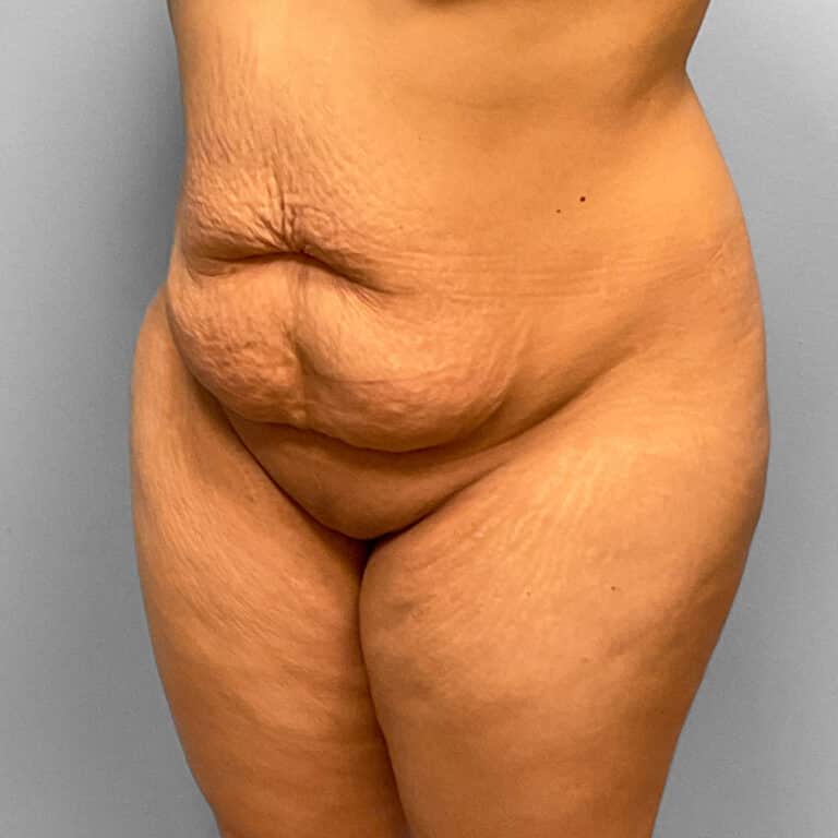 Before Image: Abdominoplasty & Lipo Dr. Tucker - left-front-oblique