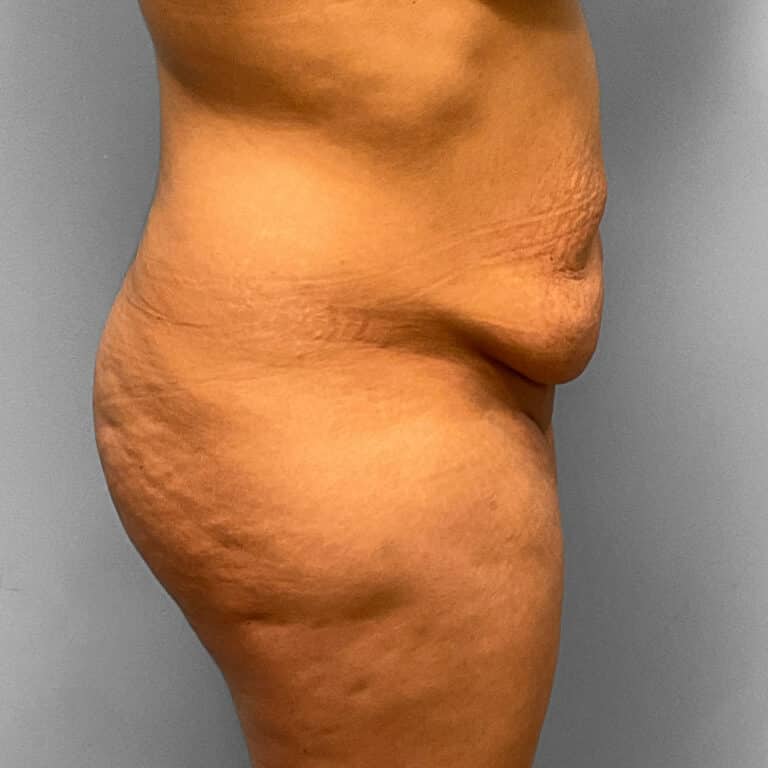 Before Image: Abdominoplasty & Lipo Dr. Tucker - right-side