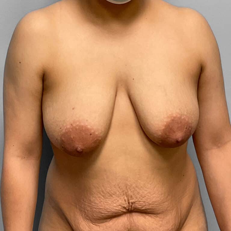 Before Image: Breast Augmentation – Dr. Tucker - front