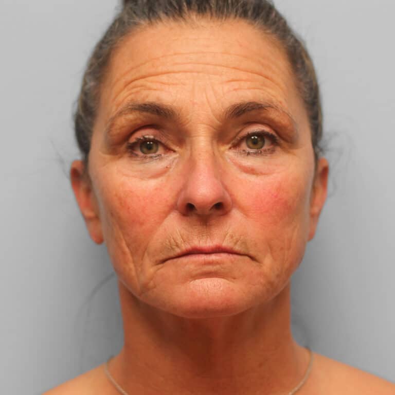 Before Image: Facelift, Browlift, TFX – Dr. Tucker - front