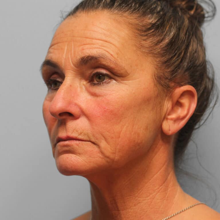 Before Image: Facelift, Browlift, TFX – Dr. Tucker - left-front-oblique