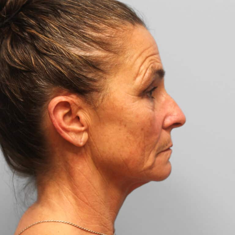 Before Image: Facelift, Browlift, TFX – Dr. Tucker - right-side